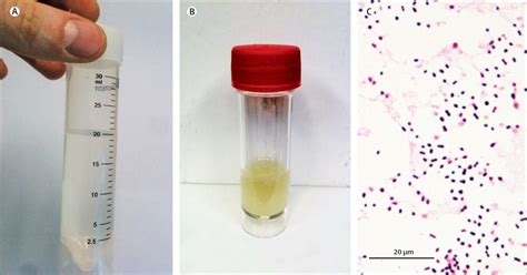 specimen bottle for spinal fluid test|CSF Specimen Collection for Analysis .